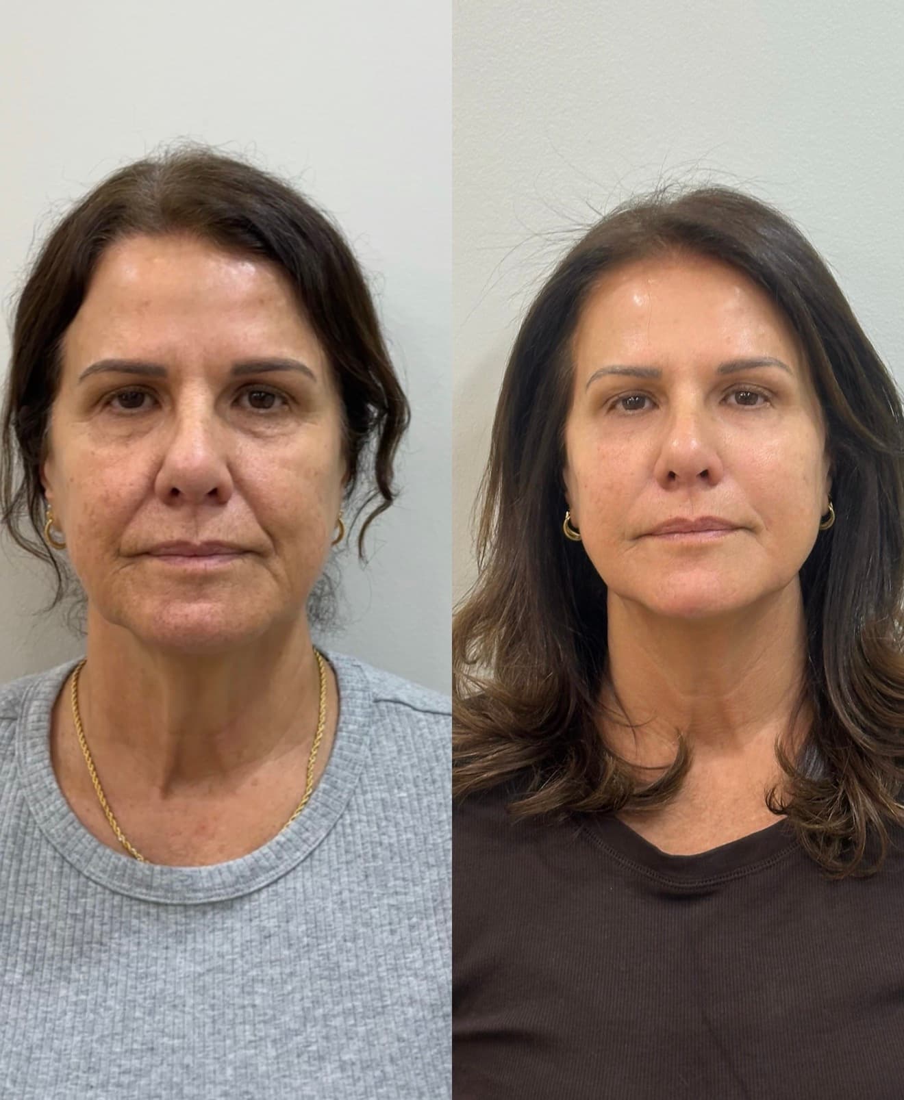 Imagem do tratamento Estruturação Facial