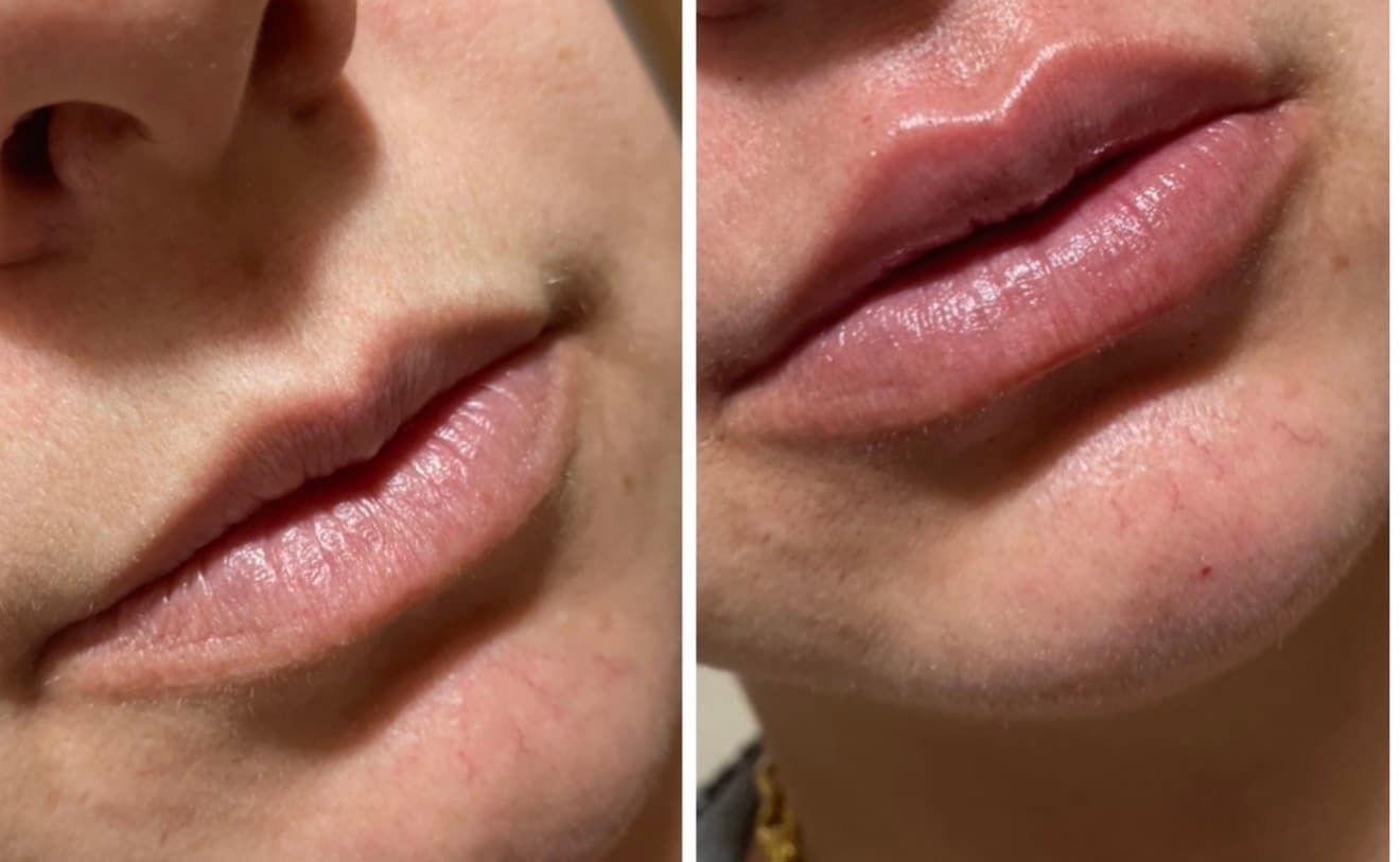 Imagem do tratamento Preenchimento Labial